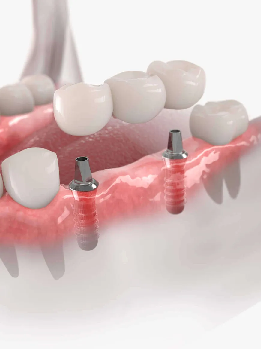 Trồng răng implant thay thế 1 vài răng